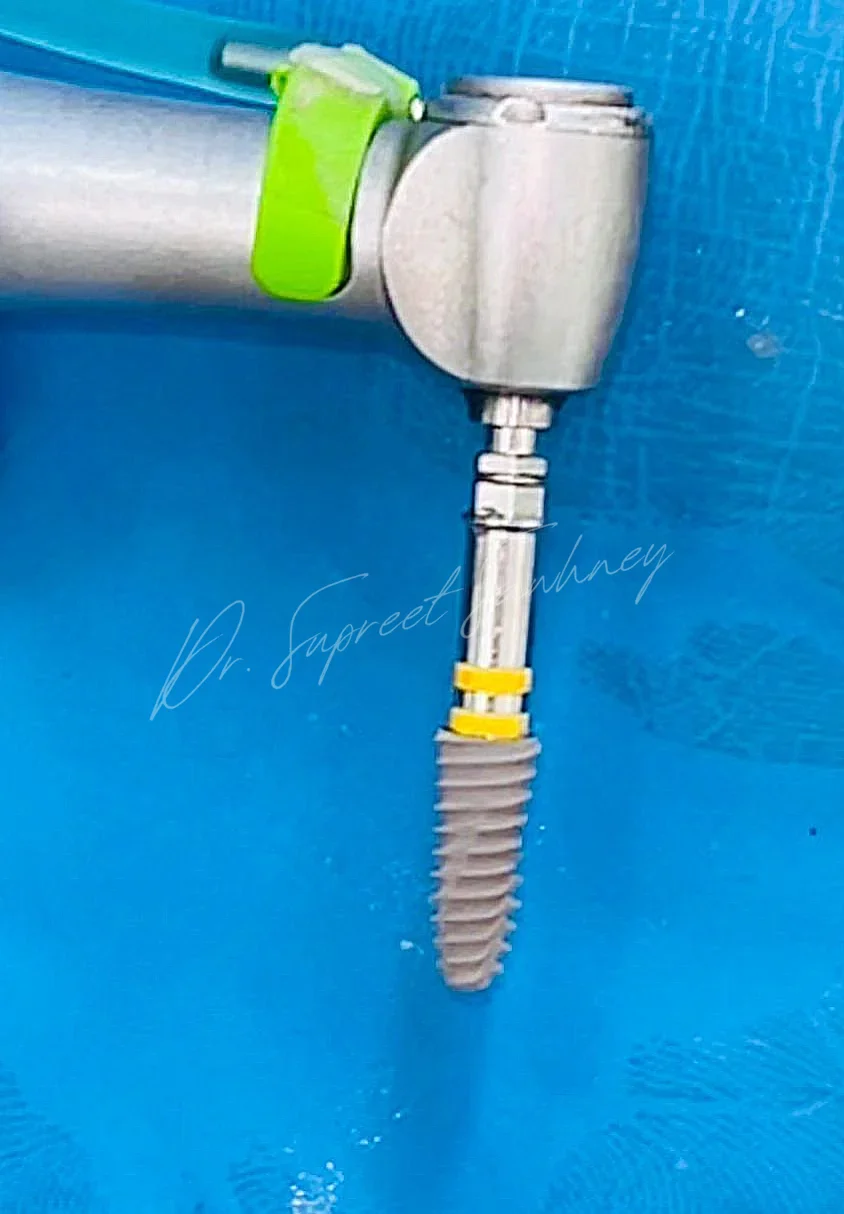 Dental implant fixture carried on a contra-angle handpiece